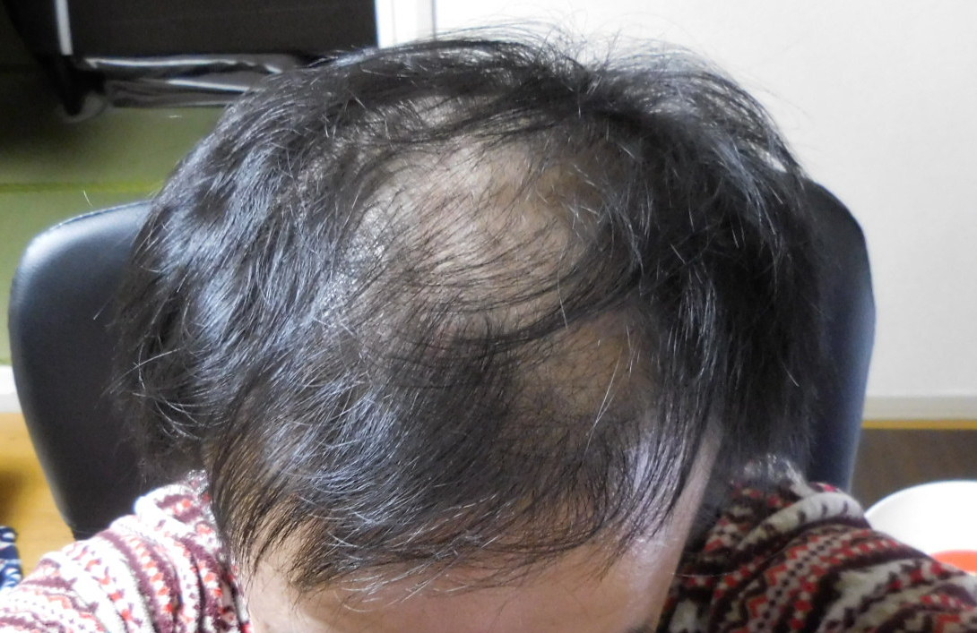 メンズ 頭皮クレンジングの効果的な方法や期間 頭皮改善で髪の毛がボリュームアップした レビュー ラジオのメール投稿特集ブログ ガンズドリバ